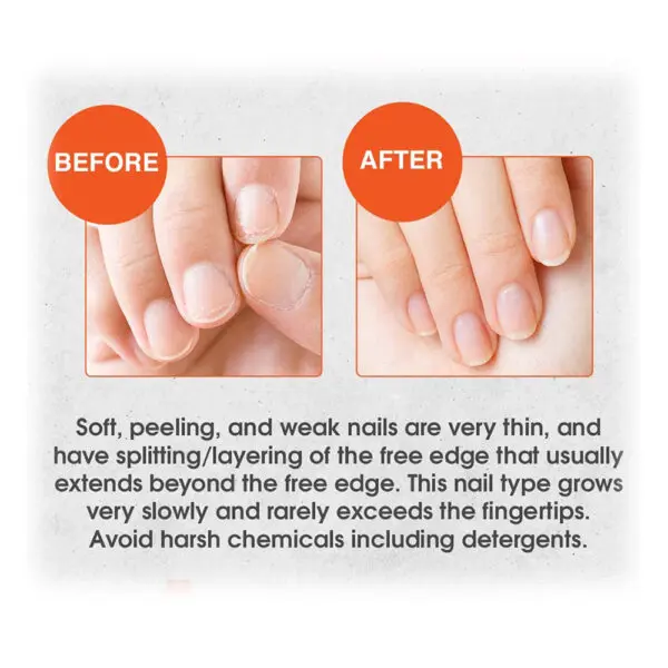 Nail-Tek-Nail-Tek-Intensive-Therapy Before and after